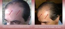 Calvicie, problemas capilares, alopecia, cabello delgado.