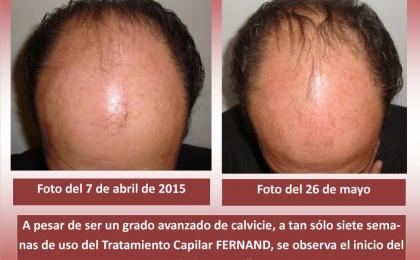 Regeneración de cabello