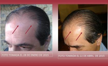 Calvicie, problemas capilares, alopecia, cabello delgado.