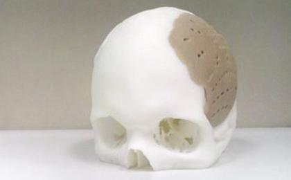 Prototipos de Protesis